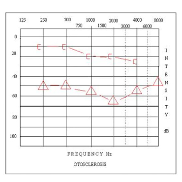 Pure Tone Audiometry Test